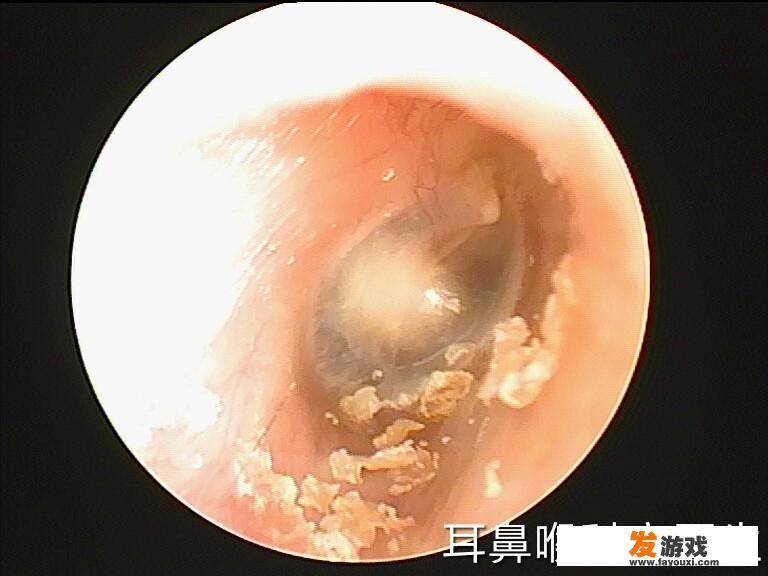 耳屎是怎么形成的？长时间不清理会影响听力吗